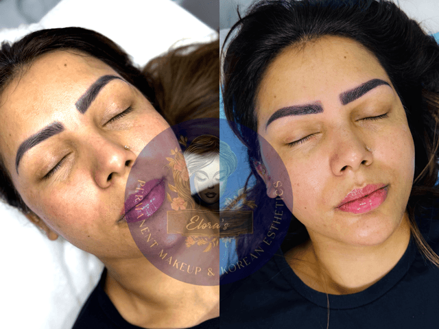Phi removal by Elora’s PMU and Korean Esthetic’s