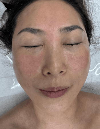 High Frequency Facial