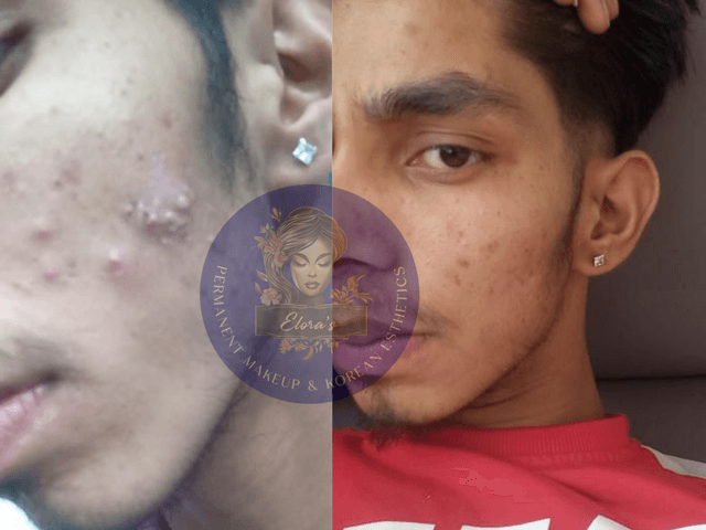 Acne Vanish Treatment