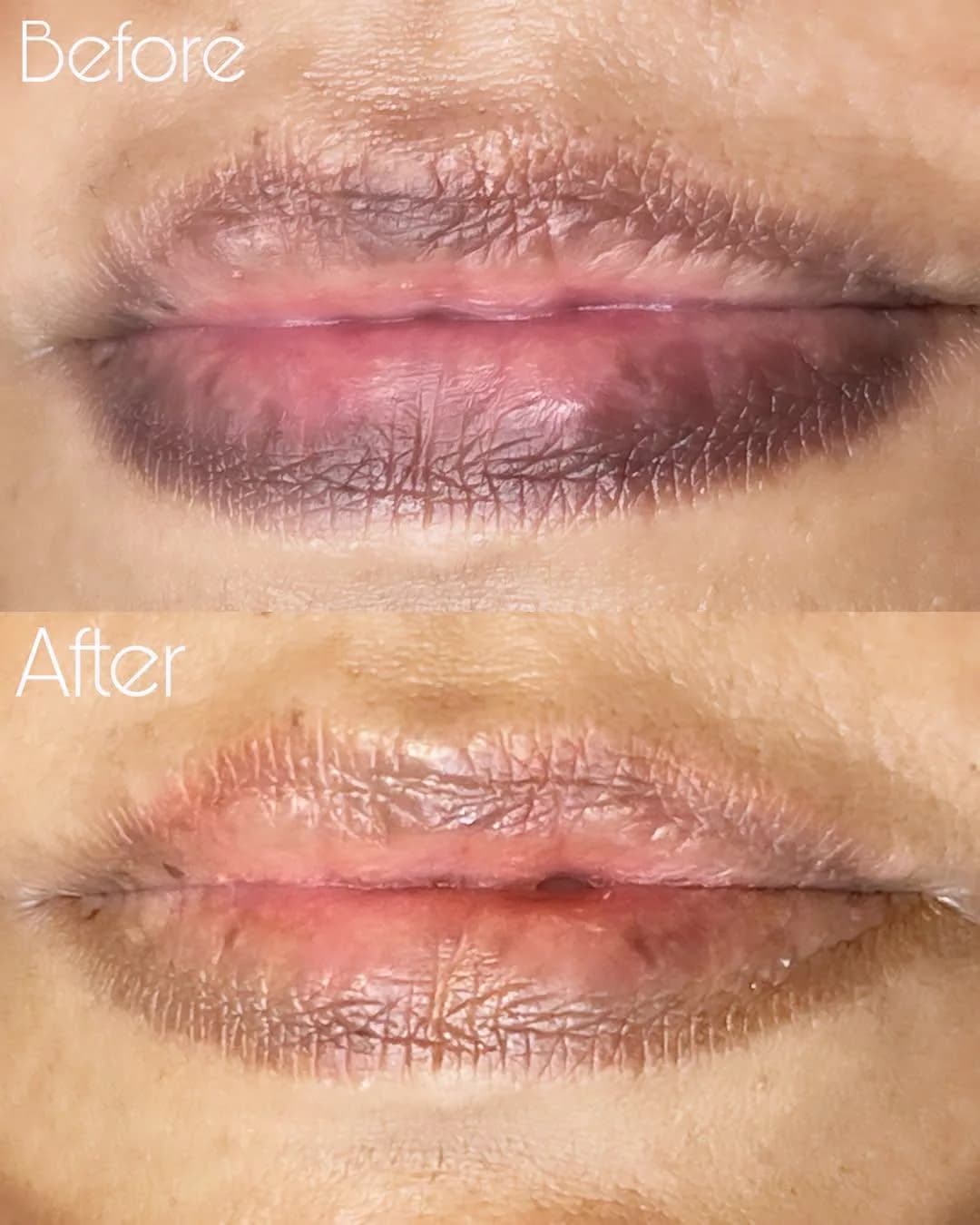 Pico laser treatment near me