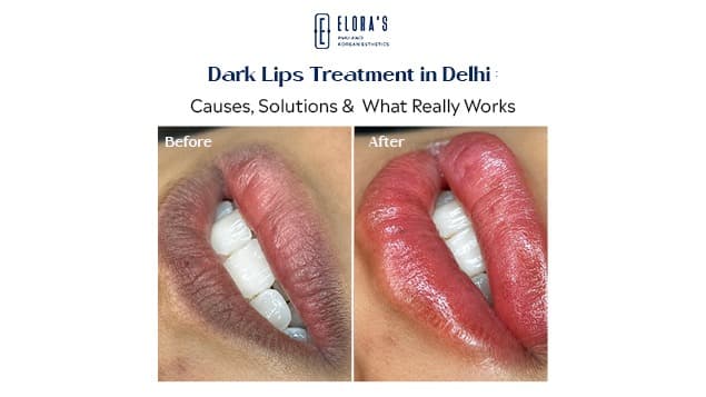 Dark Lips Treatment in Delhi