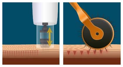Microneedling vs. Derma Rolling: Benefits, Risks, and Which One to Choose