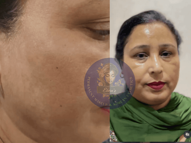 Elora PMU Treatmet Service