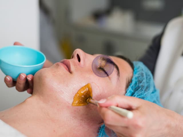 Mandelic Acid Peel Image