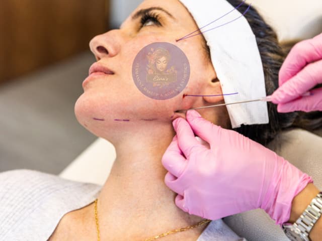 Thread Lift Image